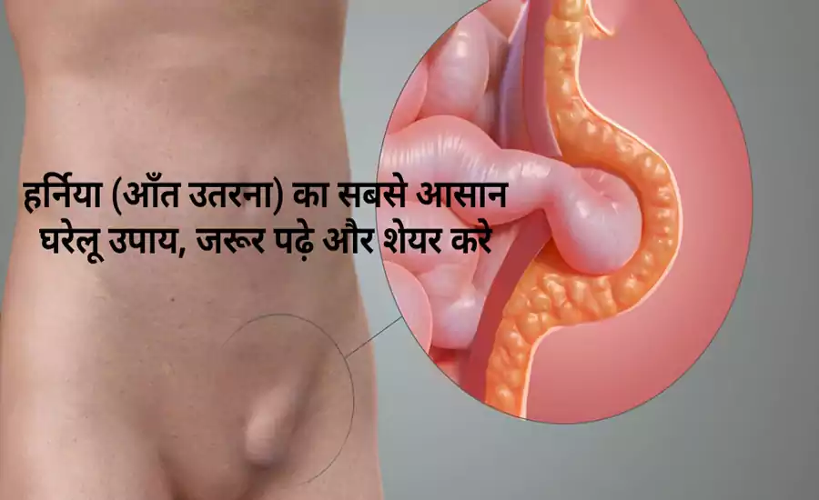 हर्निया (आंत उतरना) का सबसे आसान घरेलू उपाय, डॉक्टर के पास जाने से पहले जान लें इस देसी उपाय के बारे में हर्निया (आंत उतरना) का सबसे आसान घरेलू उपाय, डॉक्टर के पास जाने से पहले जान लें इस देसी उपाय के बारे में