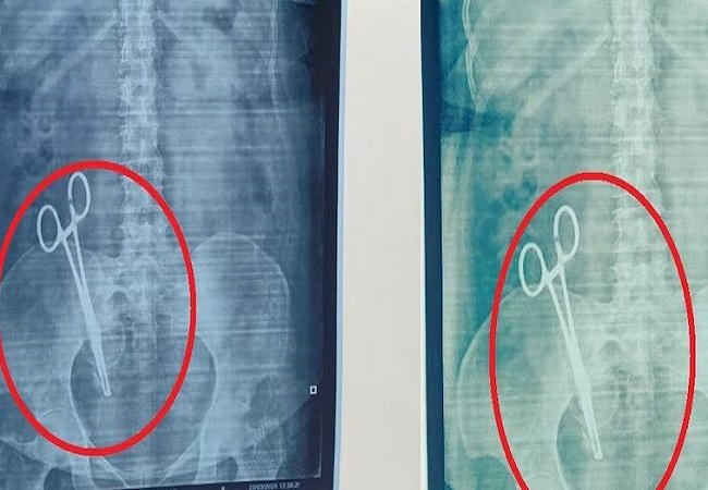 17 साल से पेट में दर्द से परेशान महिला का जब कराया गया एक्सरे, तो रिपोर्ट देख लोगो के उड़ गए होश 17 साल से पेट में दर्द से परेशान महिला का जब कराया गया एक्सरे, तो रिपोर्ट देख लोगो के उड़ गए होश