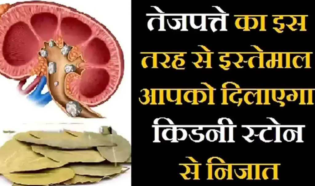 तेजपत्ते का इस तरह से करेंगे इस्तेमाल तो आपको मिलेगा किडनी स्टोन से निजात, एक बार जरूर पढ़ें ये लेख तेजपत्ते का इस तरह से करेंगे इस्तेमाल तो आपको मिलेगा किडनी स्टोन से निजात, एक बार जरूर पढ़ें ये लेख