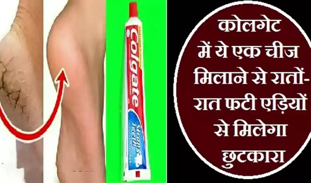 कोलगेट में ये एक चीज मिलाने से रातों-रात फटी एड़ियों से मिलेगा छुटकारा कोलगेट में ये एक चीज मिलाने से रातों-रात फटी एड़ियों से मिलेगा छुटकारा