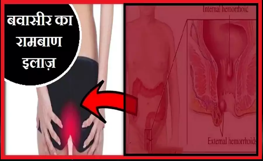 इन उपायों को करने के बाद जड़ से खत्म हो जाएगी बवासीर, बड़ा कारगर है ये देसी नुस्खा