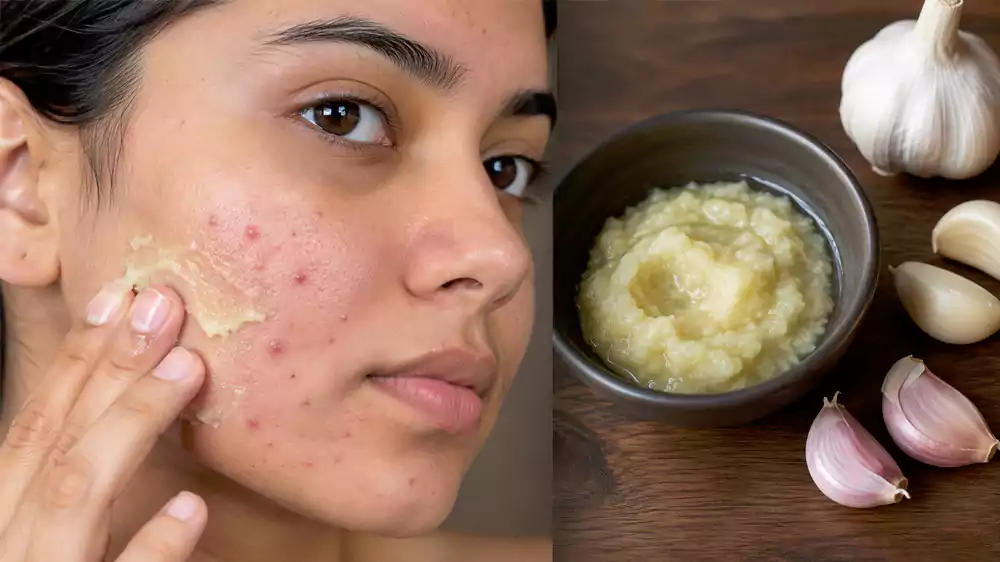 lahsun pimple